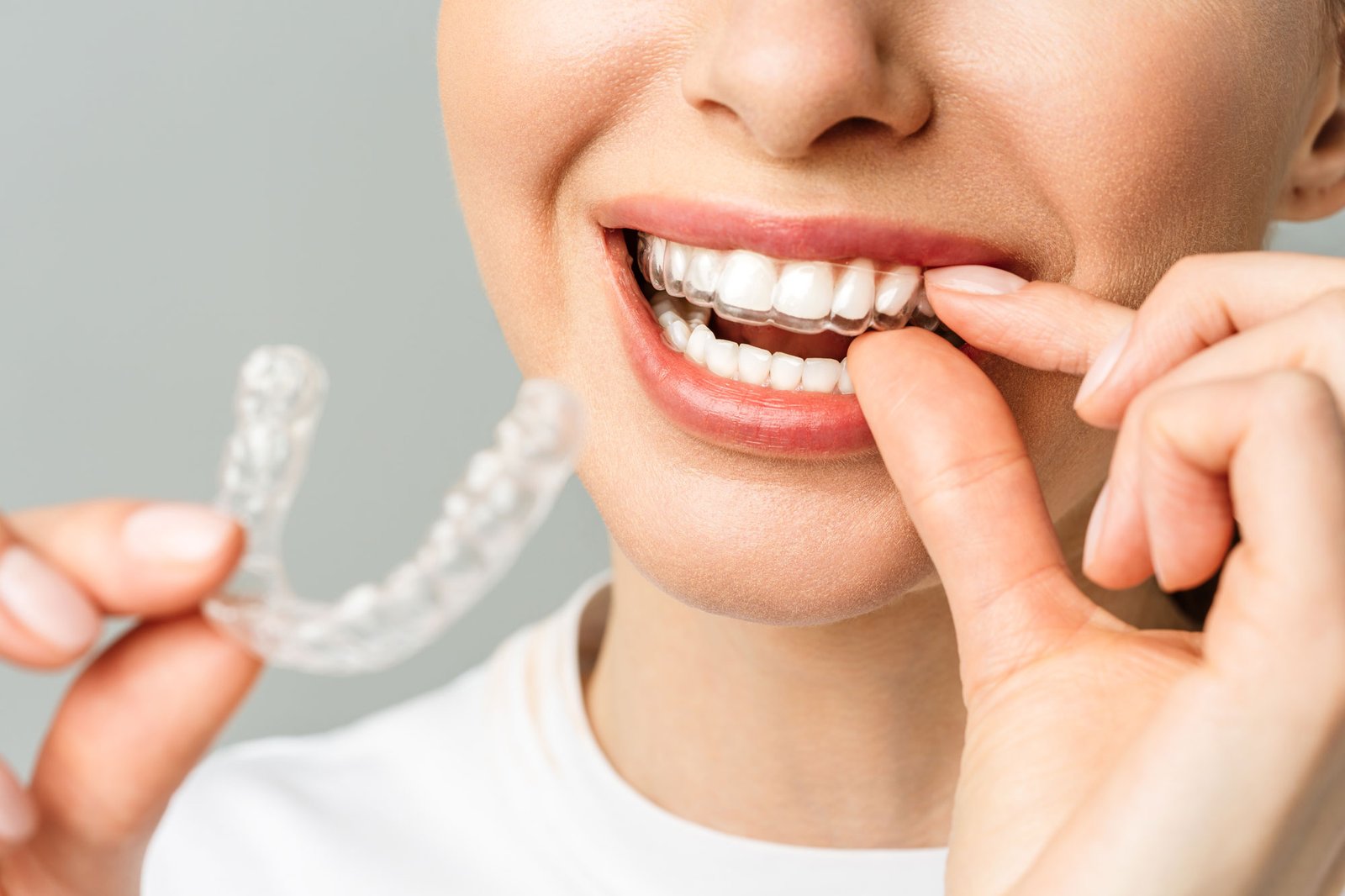 alinhadores-invisíveis-invisalign-em-são-joão-del-rei-nio-odontologia