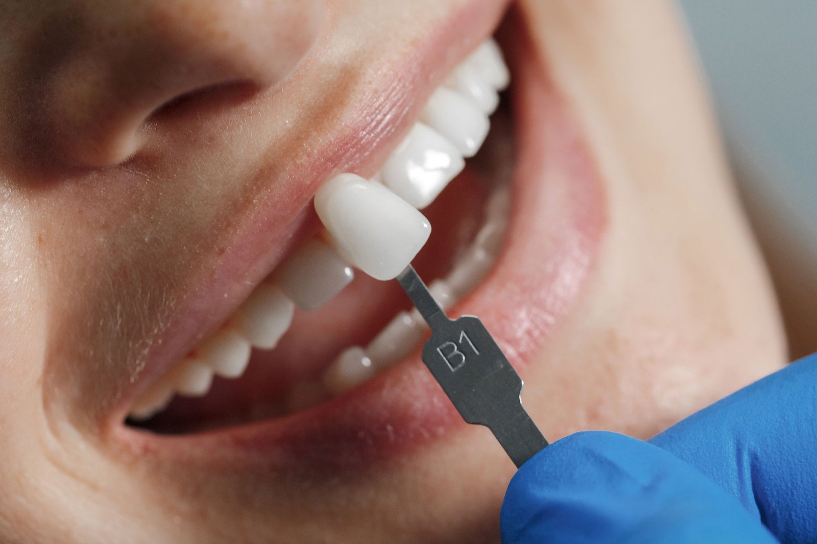 facetas-de-porcelana-em-são-joão-del-rei-mg